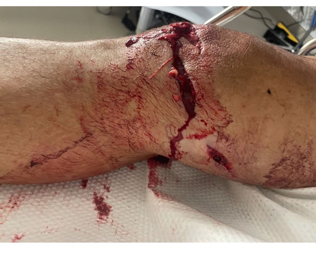 Most of our GROUP RIDES are at TEMPO PACE/Zone 3 and higher covering middle-distance courses (16 to 25 miles). We have some scheduled longer rides, chill rides and recovery rides.

As group leaders, we aim to keep our rides cohesive. However, there are times when the ride’s intensity may increase to provide riders with a better workout. Our goal is to enhance our fitness as a group and community. We typically categorize our rides as either recovery, chill or tempo rides. Visit our EVENTS page for upcoming rides to join.
I have listed ride categories based on watts/kg. Remember, every rider has a different riding ability. I base the 3 categories on my own riding ability and fittness.
Most of our GROUP RIDES are listed weekly and broken down into these 3 Categories:

1. RECOVERY (2.0 to 2.5 watts/kg) LOW INTENSITY

These rides emphasize active recovery. They consist of very low-intensity exercise sessions aimed at helping the body recuperate after a strenuous workout or race by maintaining movement while exerting minimal stress on the muscles. This approach facilitates blood flow and nutrient delivery without inducing further fatigue; essentially, it’s a very easy ride focused on light effort without pushing your limits. There will be no sprinting at the end of the ride, and the group leader will ensure the group maintains an easy, recovery pace.

2. CHILL (2.5 to 3.0 watts/kg) MODERATE INTENSITY

These rides emphasize Zone 2 – 3 efforts while maintaining group cohesion. Zone 2 and Zone 3 can vary among riders, which may lead to the formation of front, secondary, and tertiary groups. This is a moderate intensity ride. The key is to ensure that efforts remain predominantly consistent in ZONE 2 with some Zone 3 or threshold riding, but without venturing into the higher zones.


3. TEMPO (3.0 and higher watts/kg) HIGH INTENSITY
These rides concentrate on Zone 3 or THRESHOLD and higher zones. Zones may increase during climbs, breakaways, and a sprint at the end of the ride. For some riders, this is a high intensity ride and can feel like a race; however, the emphasis remains on tempo/higher cadence and threshold riding with elevated power zones to enhance fitness. The group rider will sustain a relatively steady pace that is faster than a chill ride and closer to an actual race. Tempo rides are excellent for building endurance and improving your capacity to ride at higher intensities for extended periods.


Remember that even if you fall behind the leader on these rides, there is a “rubber banding effect” feature built into the Rouvy Software. It refers to a feature in group rides where the app automatically adjusts your resistance to keep you closer to the pace of the group, essentially acting like an invisible “rubber band” that pulls you back if you fall behind, allowing riders of different abilities to stay together during a group ride. It will also make resistence harder as you pull ahead of the group leader.
